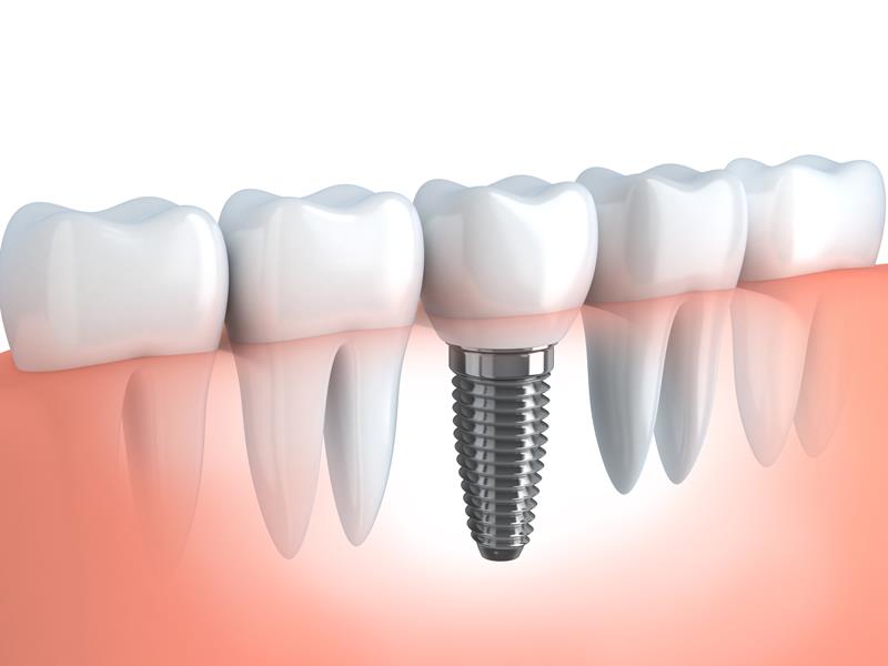 Dental Implants Staten Island, NY